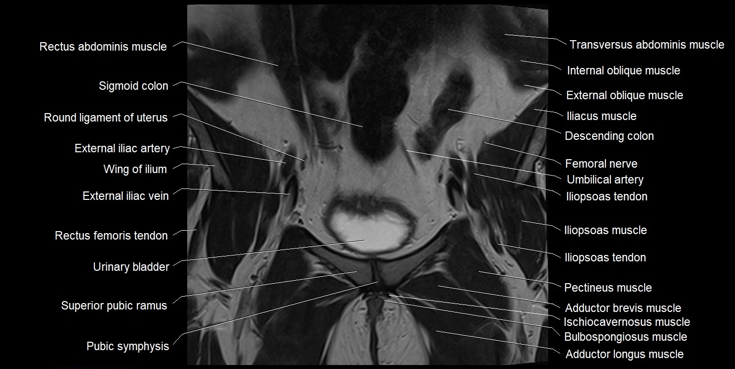 female pelvis coronal cross sectional anatomy image 9.webp